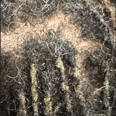 Complete Scalp Transformation at Nat-U-Reels Studios in Buford, GA